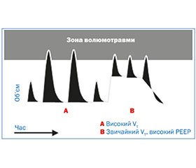 Сучасні погляди на етіологію бронхолегеневої дисплазії