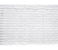 Hashimoto’s encephalopathy presenting with seizures: a case report