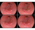 Cytomegalovirus esophagitis in an adolescent with human immunodeficiency virus infection: a clinical case