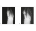 Лечение hallux valgus методом открытой малоинвазивной дистальной остеотомии с параоссальной фиксацией