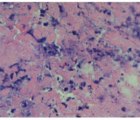 Поляризационная микроскопия коллагеновых волокон стромы инвазивного переходно-клеточного рака мочевого пузыря после неоадъювантной эндолимфатической химио- и лучевой терапии