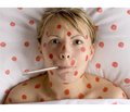 Нетипичный случай заболевания корью у пациента старшего возраста (привитого) с осложнениями со стороны нервной системы