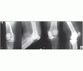 Клінічні результати одновиросткового ендопротезування колінного суглоба при медіальному остеоартрозі