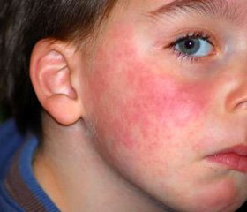 Сучасні погляди на лікування та профілактику алергічних захворювань у дітей