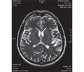 RESLES (Reversible splenial lesion syndrome)