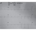 Thyrotoxic Periodic Paralysis: A Rare Case