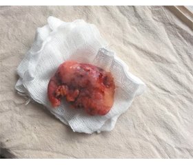 Mucocele/mucinous cystadenocarcinoma of the appendix