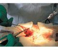 Surgical treatment of inflammations and adhesions of the abdominal cavity  in adolescents using stream hydroscalpel
