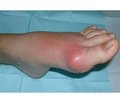 Clinical and Prognostic Significance of Serum Uric Acid as a Marker Complicated Course of Gout on the Background Pathology of Digestive Tract