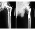 Переломи проксимального відділу стегнової кістки: соціальна значимість і тактика хірургічного лікування (огляд джерел літератури)