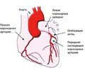 Основы диагностики инфаркта миокарда на уровне экстренной медицины