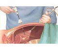 Diagnosis and Treatment of Abdominal Infiltrates in Children