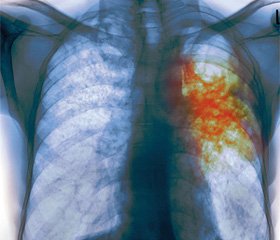Сучасний стан питання діагностики туберкульозу