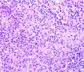 Histiocytosis of Langerhans Cells in Children