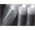 Остеосинтез перипротезних переломів стегнової кістки (тип В1) після ендопротезування кульшового суглоба