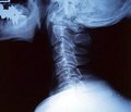 Влияние методов постизометрической релаксации на состояние церебральной венозной гемодинамики у больных молодого возраста с нестабильностью шейного отдела позвоночника
