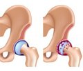 Efficiency of Physiotherapy in Treatment of Severe Pain Syndrome in Elderly Patients with Coxarthrosis