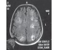 Синдром задней обратимой энцефалопатии (posterior reversible encephalopathy syndrome — PRES) в акушерстве