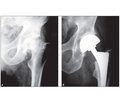 Хірургічне лікування медіальних переломів шийки стегнової кістки