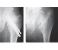 Можливості фіксатора та кісткової пластики в лікуванні переломів і псевдоартрозів шийки стегнової кістки
