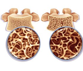 The Defeat of Bone Tissue in Patients with Fatty Illness of Liver