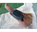 Use of Vacuum Therapy in the Treatment of Wounds in Patients with Diabetic Foot Syndrome
