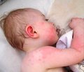 Деласкин — новые возможности терапии атопического дерматита у детей в Украине