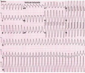 Клінічний випадок персистуючої фібриляції шлуночків серця на тлі синдрому Torsade de pointes та багаторазової електроімпульсної терапії — дефібриляції