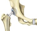 Ендопротезування кульшового суглоба в людей старших вікових груп при внутрішньосуглобових переломах шийки стегна