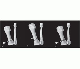 Особливості виконання корегувальних остеотомій першої плеснової кістки при hallux valgus