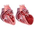 Heart Failure with Preserved Left Ventricular Ejection Fraction