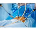Risks of anaesthesia in laparoscopic interventions in the abdominal cavity