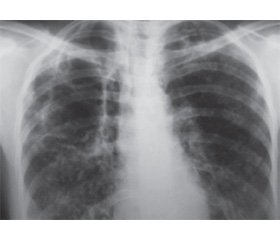Синдром исчезающего легкого при туберкулезе