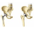 Femoral geometry and FRAX indices as independent risk factors for hip fractures in Ukrainian patients