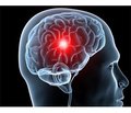 Diagnostics and correction of multiorgan disorders for critical patients with a hemorrhagic stroke