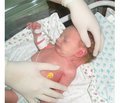 Випадок поєднання гіперпролактинемічного гіпогонадизму з мозаїчним варіантом синдрому Шерешевського — Тернера