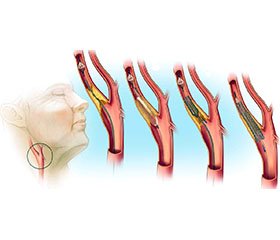 Атеросклеротическое поражение сонных артерий у пациентов с ишемической болезнью сердца