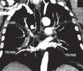 Принципы ведения пациентов с субмассивной тромбоэмболией легочной артерии. Клинический случай