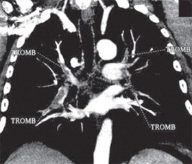 Принципы ведения пациентов с субмассивной тромбоэмболией легочной артерии. Клинический случай