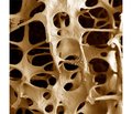 State of the Bone Tissue in the Premenopausal Women: the Frequency of athology, Risk Factors
