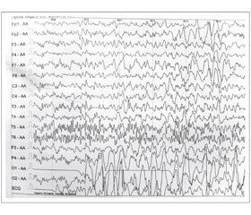 Рефлекторные эпилепсии. Эпилепсия горячей воды у ребенка 10 месяцев (собственное наблюдение)