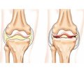 The influence of metabolic disorders on clinical manifestations of osteoarthritis and the method for predicting of its course