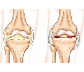 The influence of metabolic disorders on clinical manifestations of osteoarthritis and the method for predicting of its course