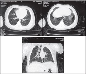 On the Problems of Early Diagnosis of Interstitial Lung Diseases in Children (Analysis of Clinical Cases)
