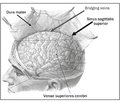 Postdural Puncture Headache: Etiology, Pathogenesis, Manifestations