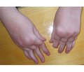 Evaluation of Manifestations of Juvenile Rheumatoid Arthritis and Its Outcomes in Long-Term Follow-Up (5–10–15 Years)