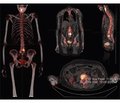 Перспективи кількісної оцінки результатів однофотонної емісійної комп’ютерної томографії кісткової системи (огляд літератури)