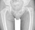 Рентгенологічні показники диспластичних деформацій дистального кінця стегнової кістки у фронтальній площині