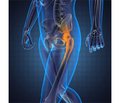 Allelic Polymorphism of FDPS Gene in Prognosis of Osteoporosis in Young Patients with Osteoarthritis