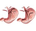 Stages of diagnosis of pathological gastroesophageal reflux in children